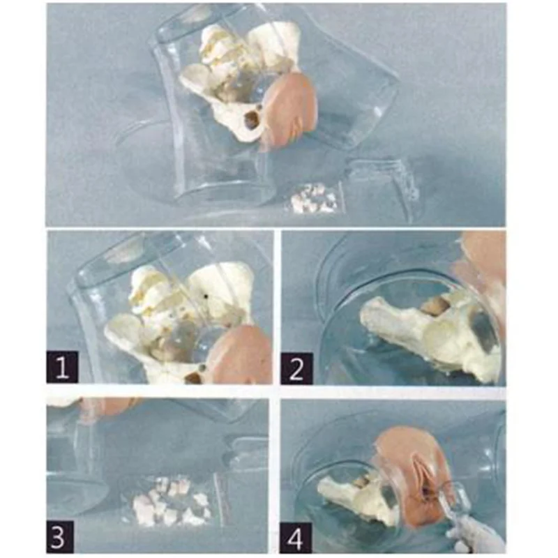 
			Modelo de curetaje transparente T32 ARI Equipos médicos de alta calidad		